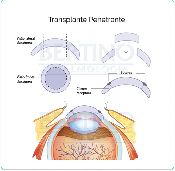 Ilustração: Transplante de córnea penetrante