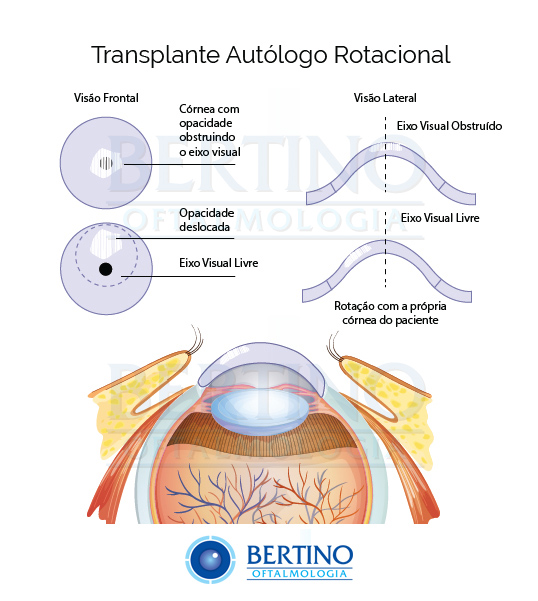 Ilustração: Transplante Penetrante Rotacional