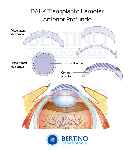 Ilustração: Transplante de Córnea Lamelar Anterior Profundo — DALK