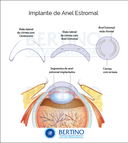 Ilustração: Implante de Segmento de Anel Intracorneano - Implante Estromal