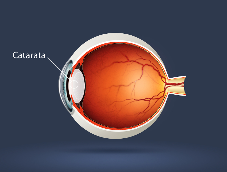 Ilustração: Cirurgia de Catarata